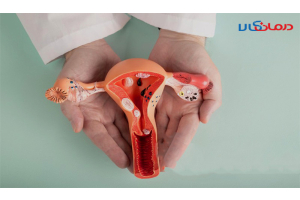 برای درمان کیست تخمدان چی بخوریم؟