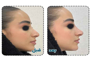 اصلاح فرم بینی بدون عمل جراحی و هزینه کمتر