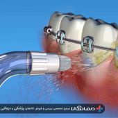 waterpik-orthodontic-tip-wp100-1