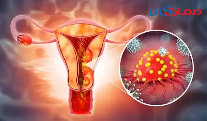 چگونه عفونت رحم را تشخیص دهیم و درمان کنیم؟