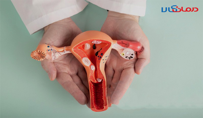 برای درمان کیست تخمدان چی بخوریم؟