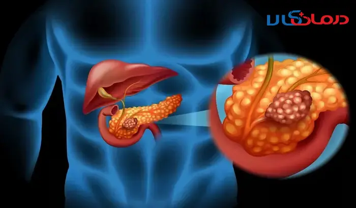 سرطان لوزالمعده سرطان پانکراس