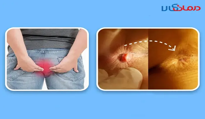 بواسیر چیست و بهترین روش درمان خانگی بواسیر