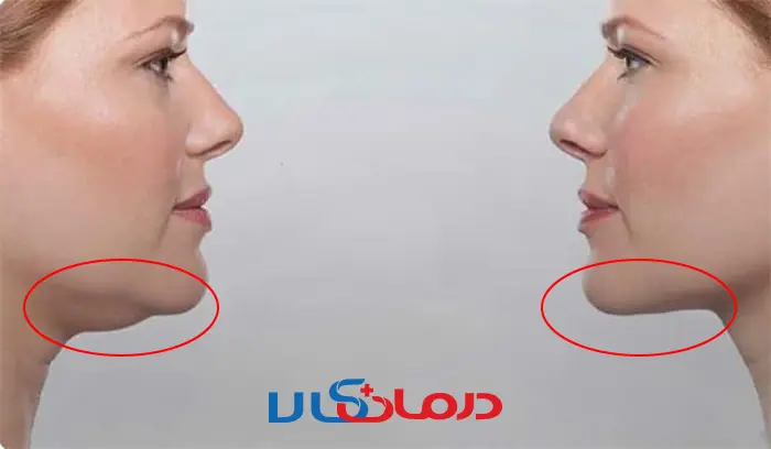 بهترین روش از بین بردن غبغب در خانه