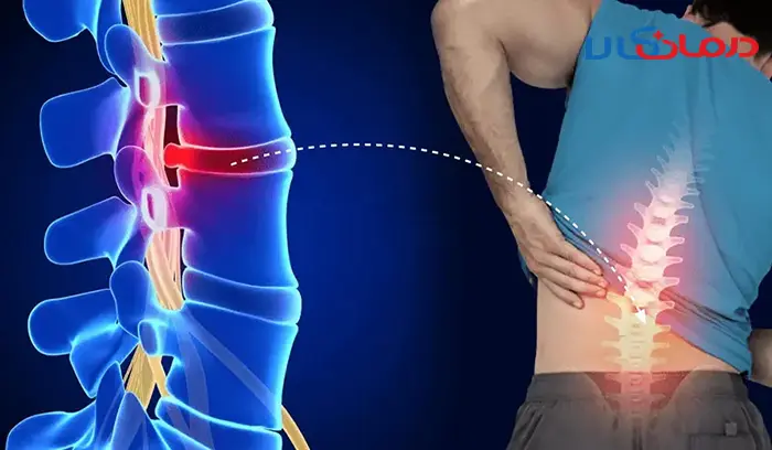 آیا دیسک کمر و تنگی کانال نخاع درمان دارد؟