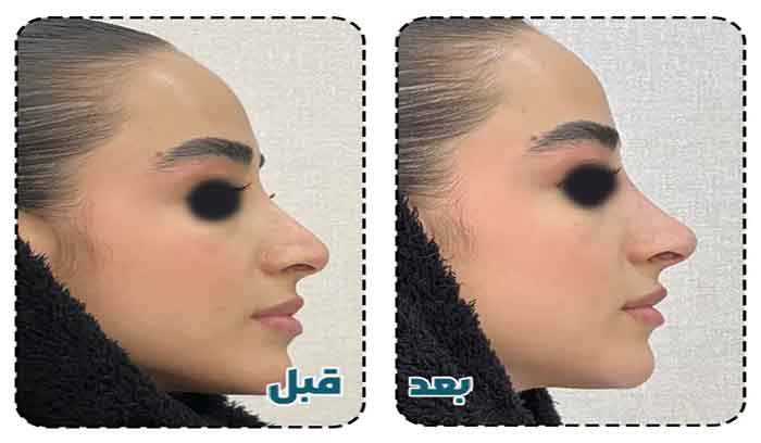 اصلاح فرم بینی بدون عمل جراحی و هزینه کمتر
