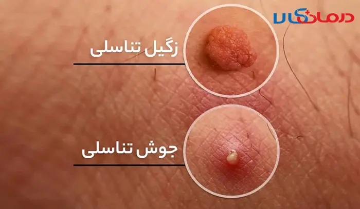 زگیل تناسلی یا hpv چیست؟ + راه تشخیص زگیل تناسلی و درمان آن