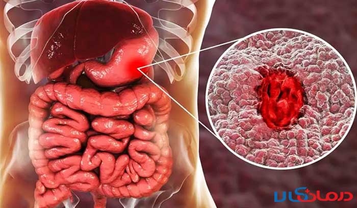 علائم زخم معده و سرطان معده، تفاوت