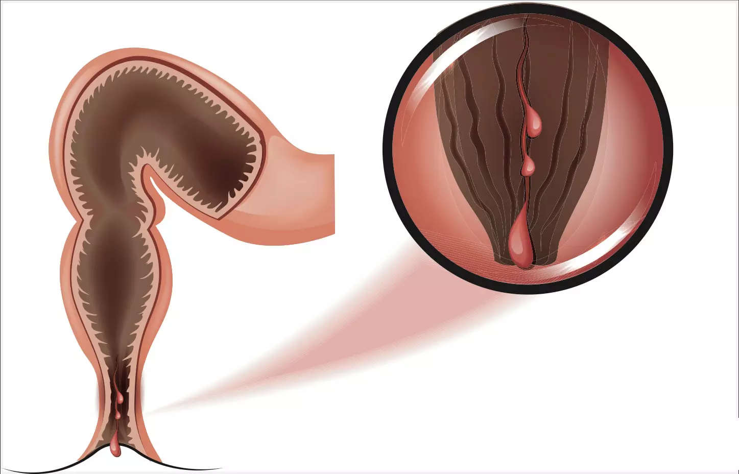 درمان شقاق با بتادین
