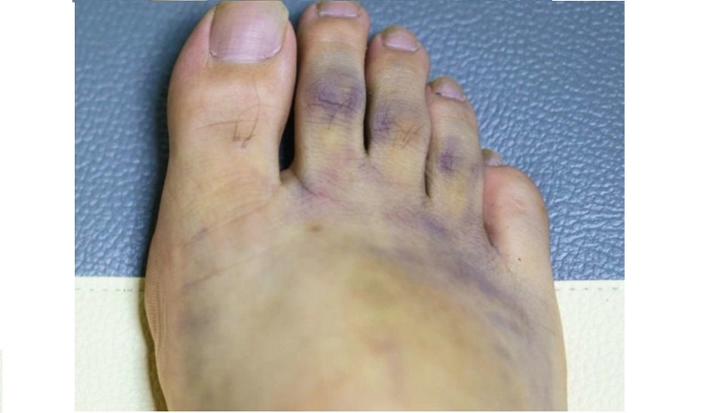 blue foot toe