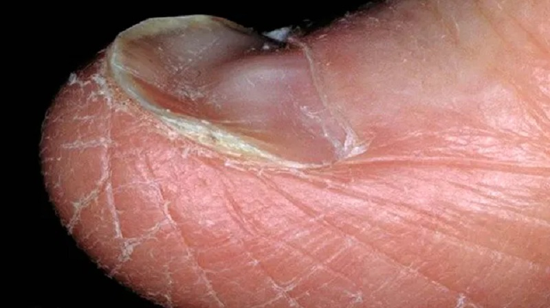 spoonshape toenail