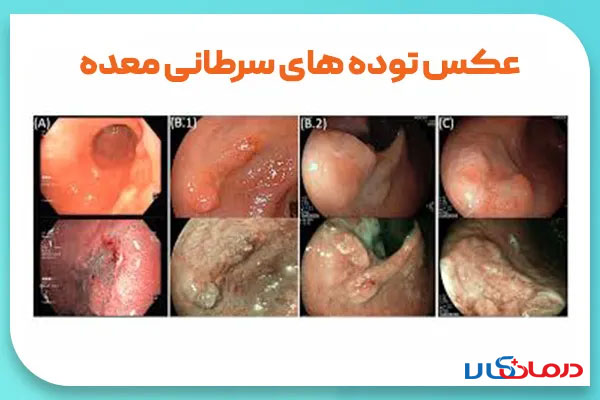 عکس زخم معده سرطانی