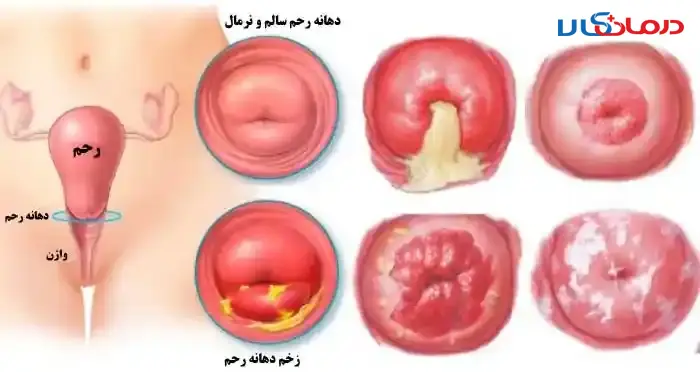 چگونه عفونت رحم را تشخیص دهیم و درمان کنیم؟