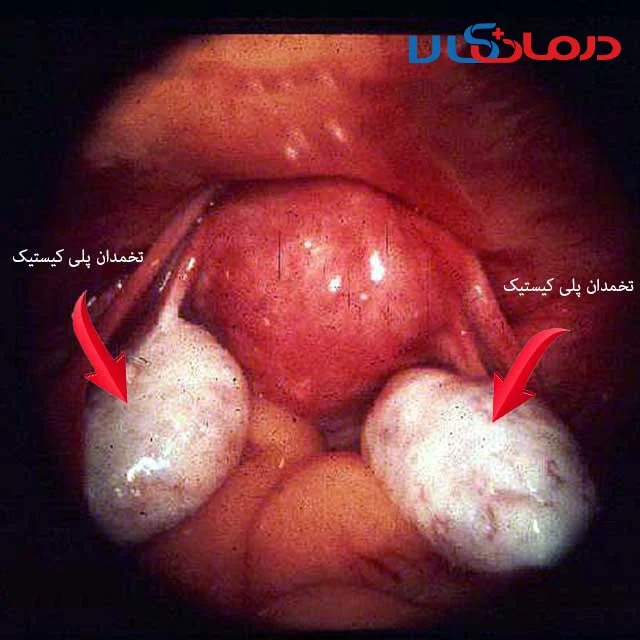عکس تخمدان پلی کیستیک