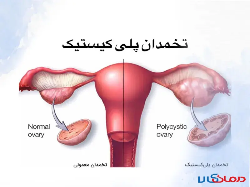 برای تنبلی تخمدان چه بخوریم