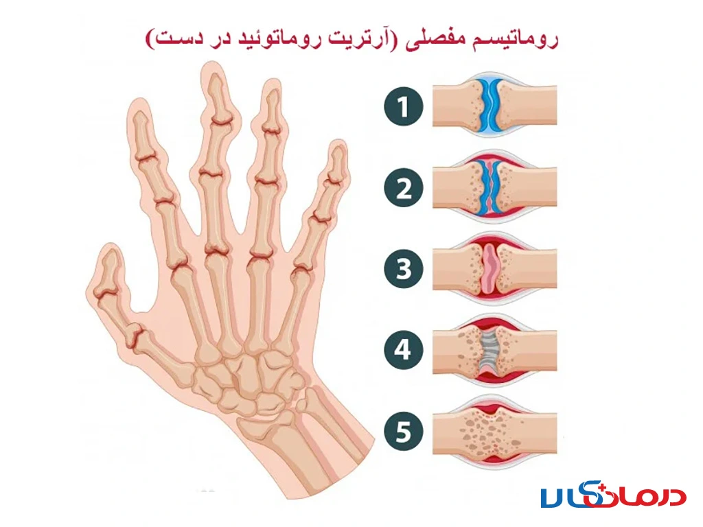 انواع روماتیسم و 6 راه پیشگیری از روماتیسم