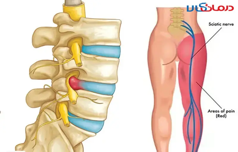 آیا دیسک کمر و تنگی کانال نخاع درمان دارد؟