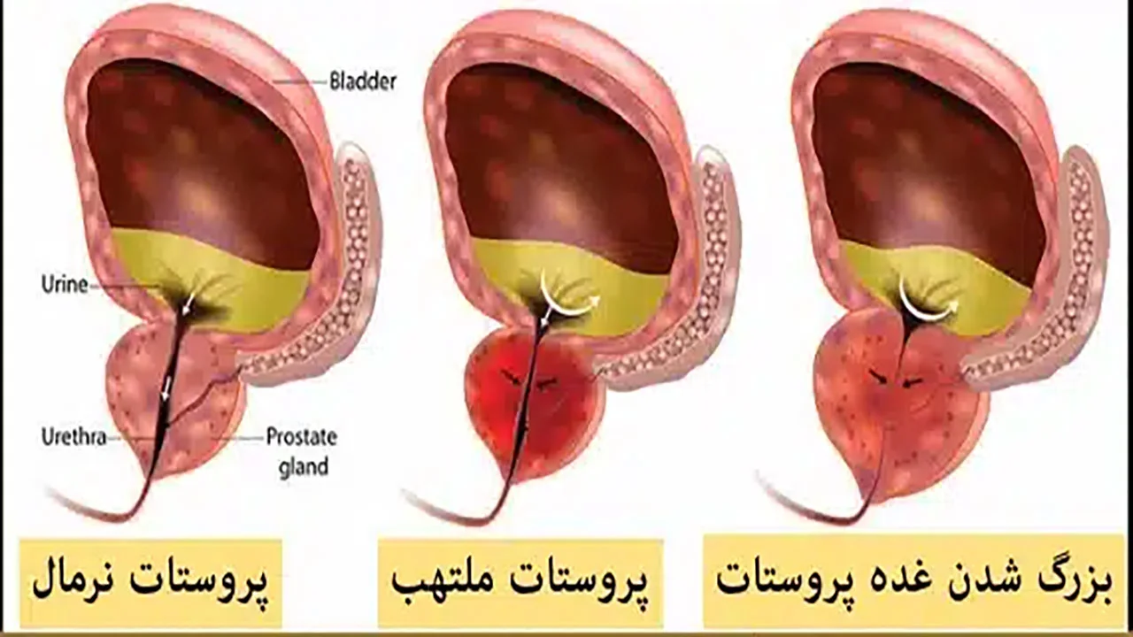 پروستات چیست و چگونه درمان می شود؟
