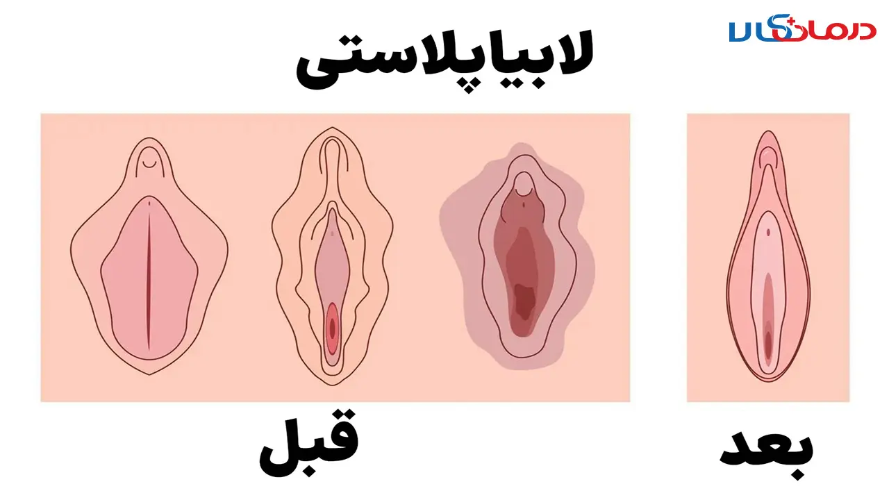 عکس قبل و بعد از عمل لابیاپلاستی