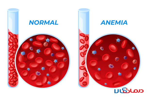 غذاهای مضر  و مفید برای کم خونی