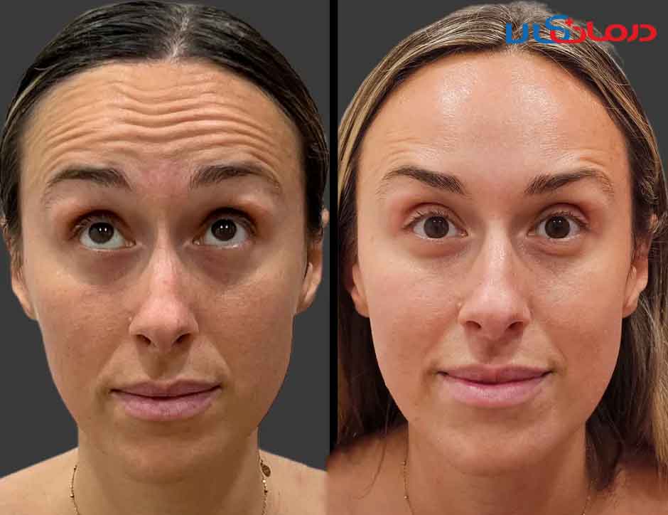 عکس قبل و بعد بوتاکس صورت