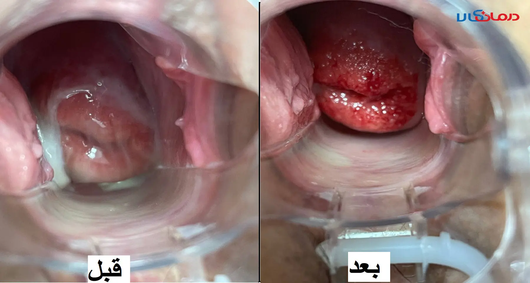 چگونه عفونت رحم را تشخیص دهیم و درمان کنیم؟