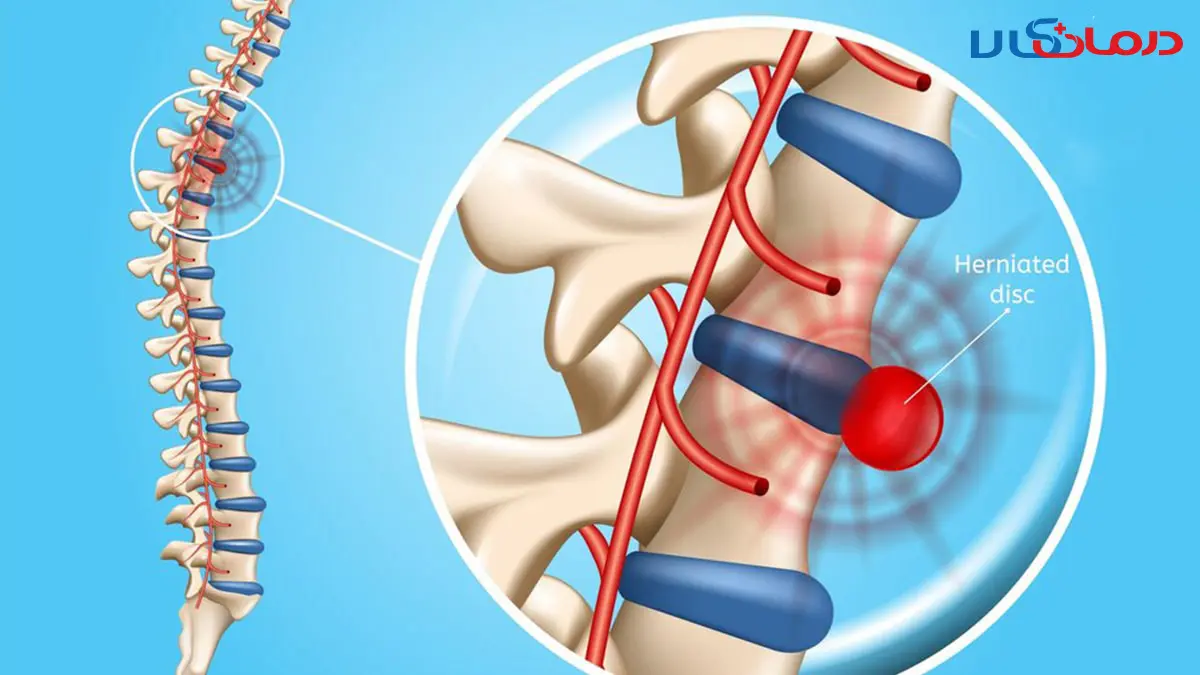 آیا دیسک کمر و تنگی کانال نخاع درمان دارد؟