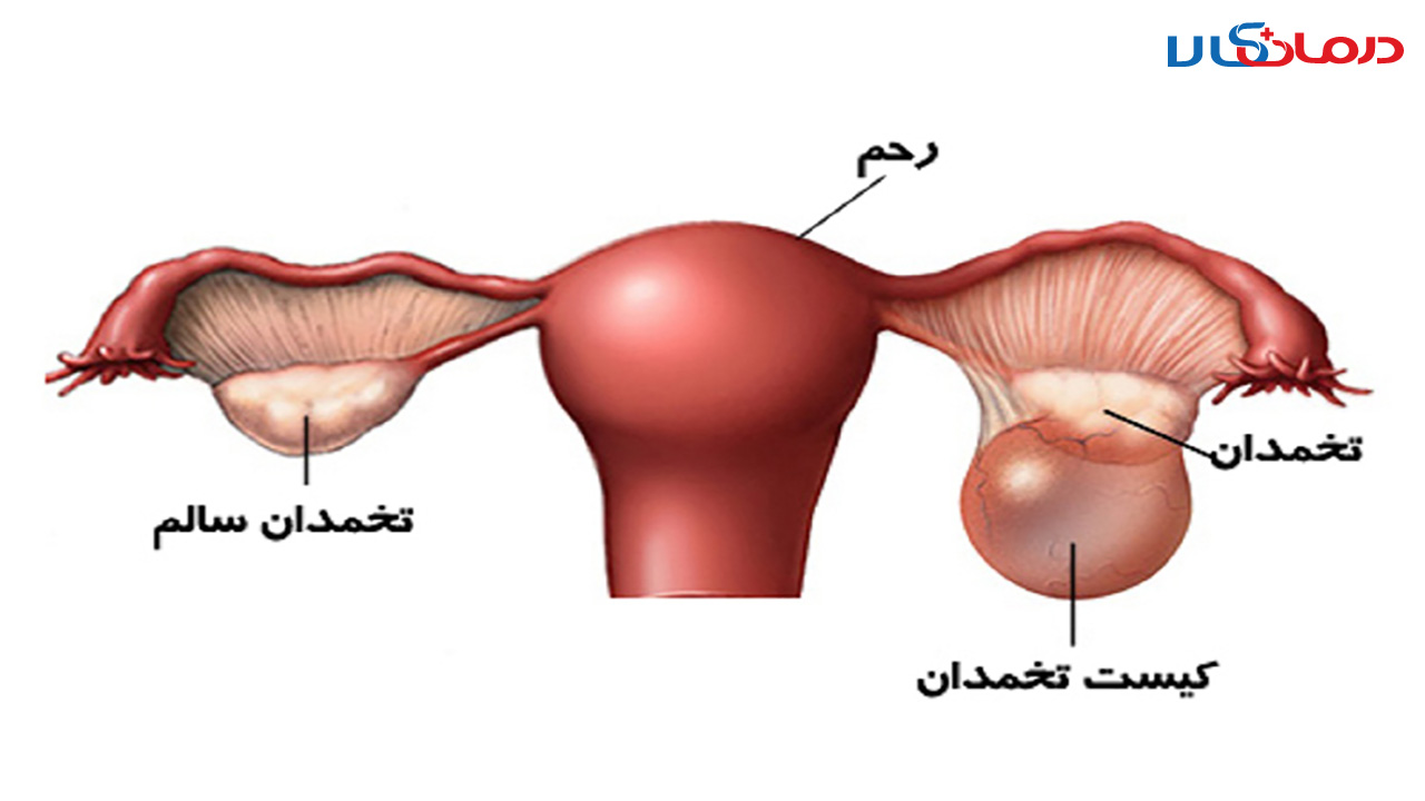 کیست تخمدان