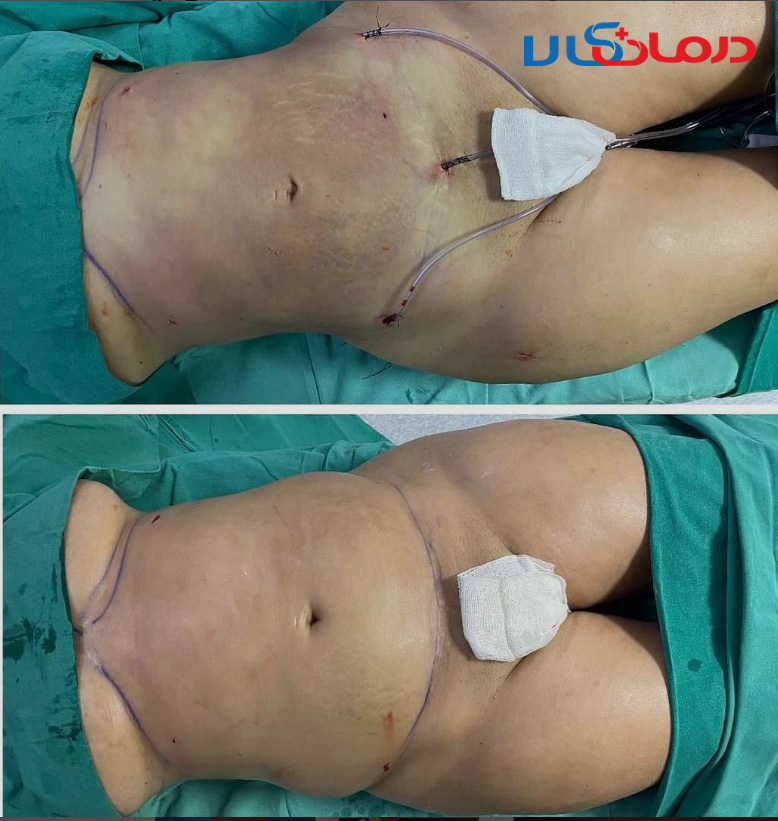 عمل لیپوماتیک