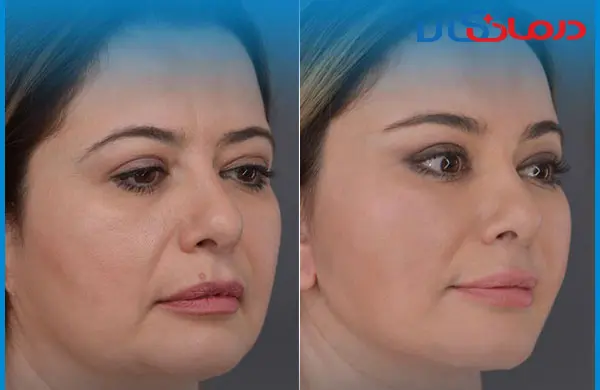 عکس های لیفت صورت با نخ