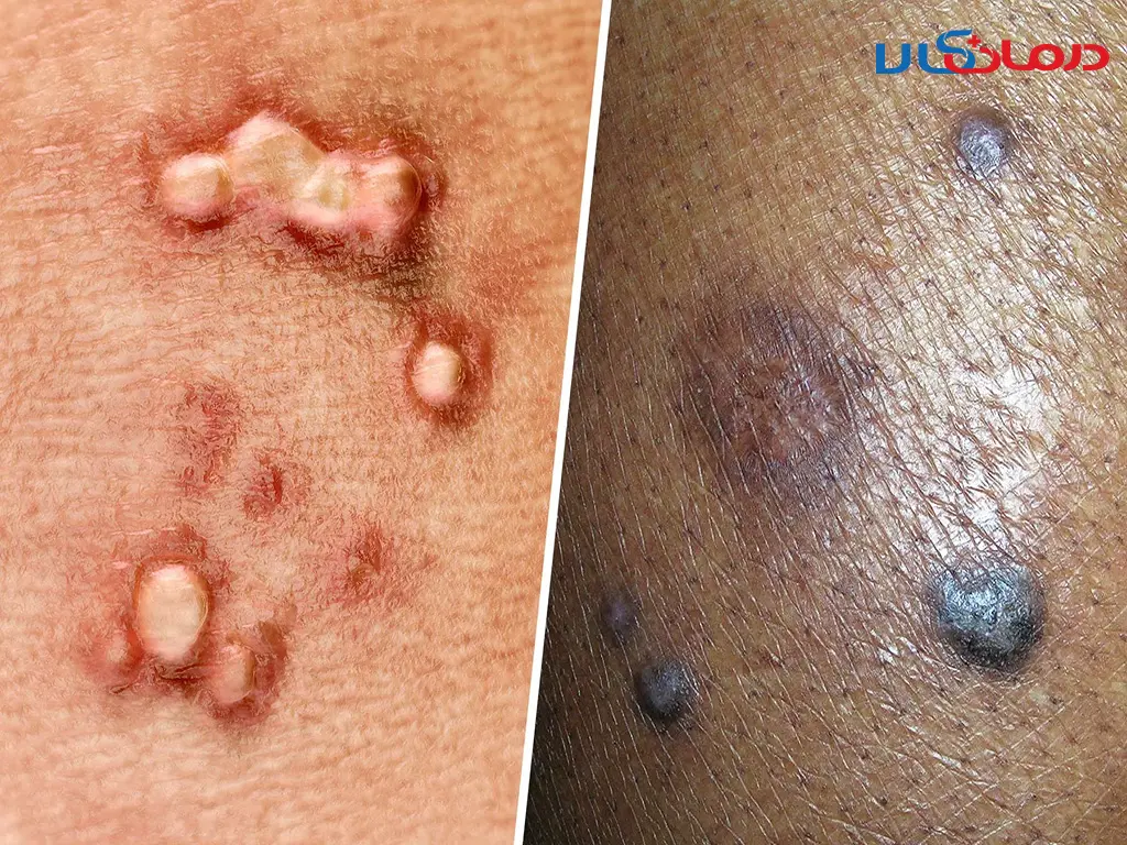 عکس زگیل تناسلی در مردان