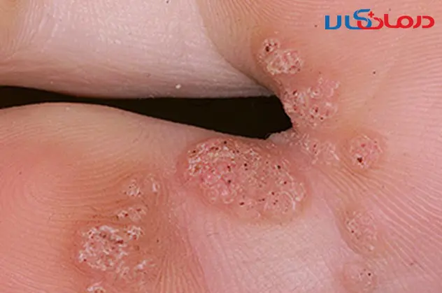 عکس زگیل تناسلی در زنان
