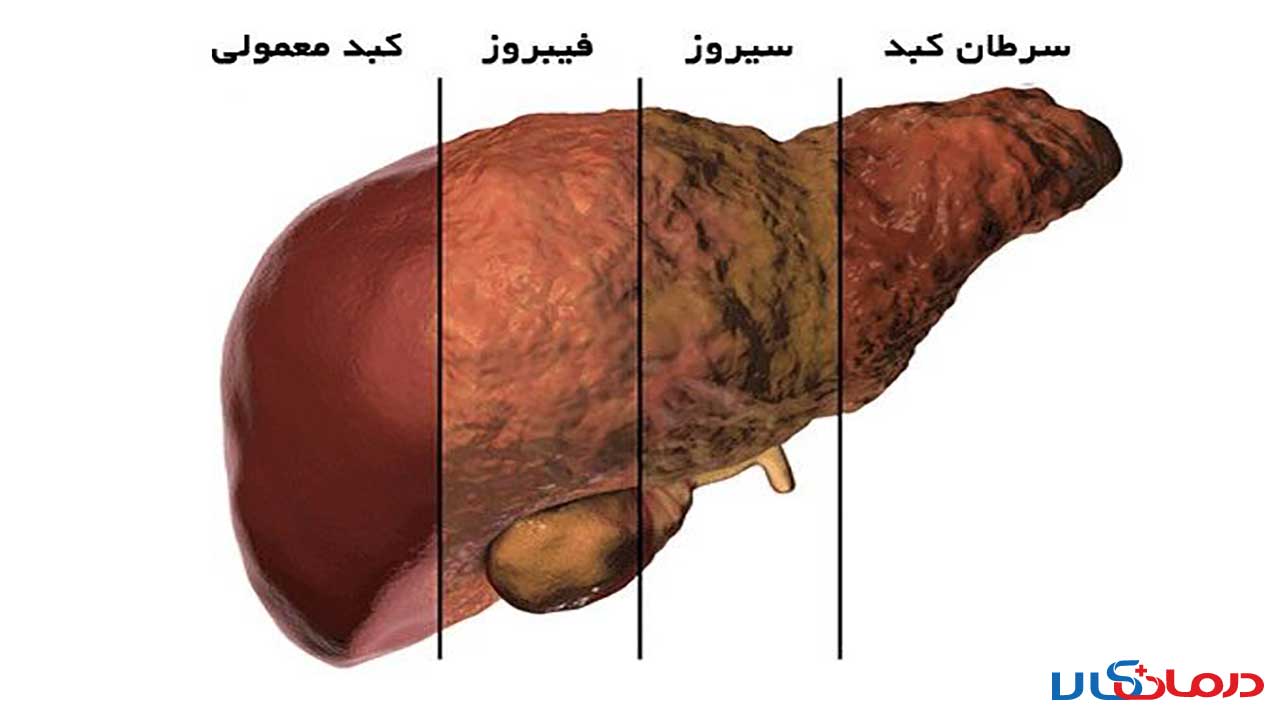 عکس کبد چرب
