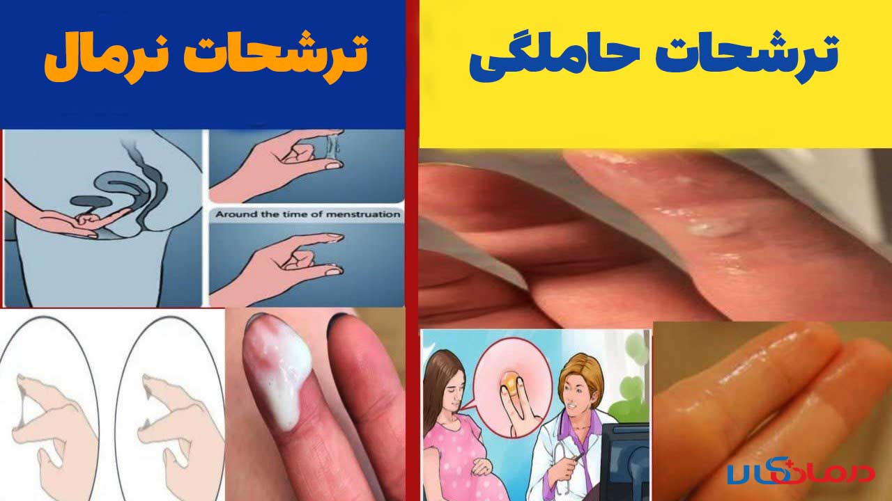 ّتفاوت ترشحات قبل از پریودی و بارداری